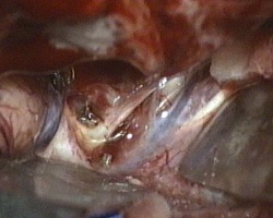 nervo ottico di sinistra nella cisterna ottico-chiasmatica