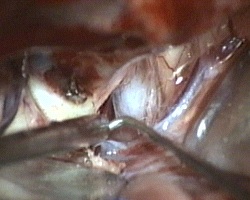 nervo ottico di sinistra e arteria carotide