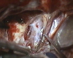 nervo ottico, arteria carotide e III nervo cranico, apertura della scissura di Silvio nella sua porzione mediale