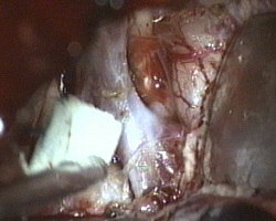 colletto dell'aneurisma della biforcazione della carotide di sinistra . Sono visibili A1 e M1 di sinistra