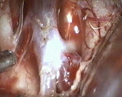 colletto dell'aneurisma della biforcazione della carotide di sinistra. Sono visibili A1 e M1