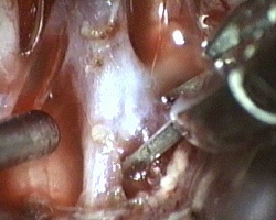 applicazione di clip sul colletto dell'aneurisma