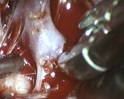 rottura della sacca dell'aneurisma durante la chiusura della clip