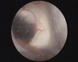 ingresso dell'endoscopio nel ventricolo laterale destro: forame di Monro occupato dalla cisti, plesso corioideo e ingresso nel corno temporale del ventricolo laterale destro