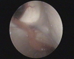 plesso corioideo e ingresso nel corno temporale del ventricolo laterale destro