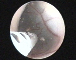 introduzione attraverso endoscopio rigido di catetere ventricolare per la perforazione della cisti