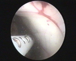 perforazione della cisti del craniofaringioma