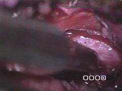 verifica della perviet del forame di coniugazione della radice di S1 a sinistra