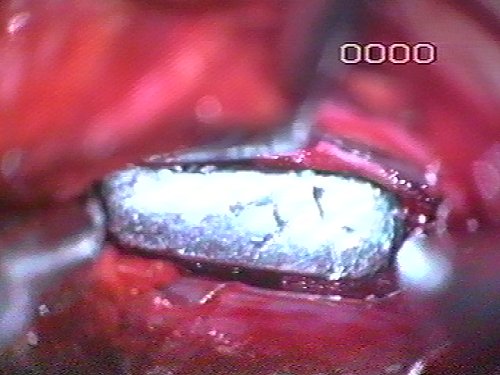 introduzione del ferro per la verifica della perviet del forame di coniugazione