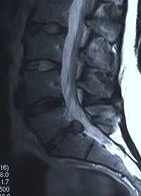 RMN del tratto lombo sacrale con evidenza di voluminosa ernia del disco L5-S1