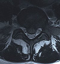 RMN del tratto lombo sacrale con evidenza di voluminosa ernia del disco L5-S1