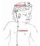 derivazione ventricolo-peritoneale