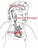 derivazione ventricolo-atriale