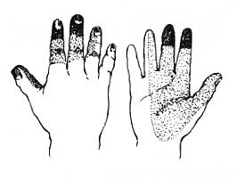 perdita sensibilità alle dita della mano