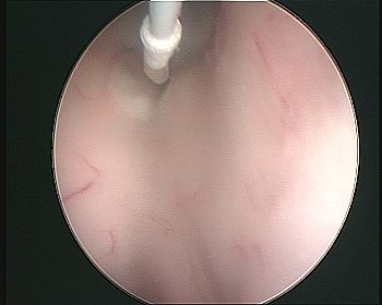 catetere per ventricolostomia sul tuber cinereum